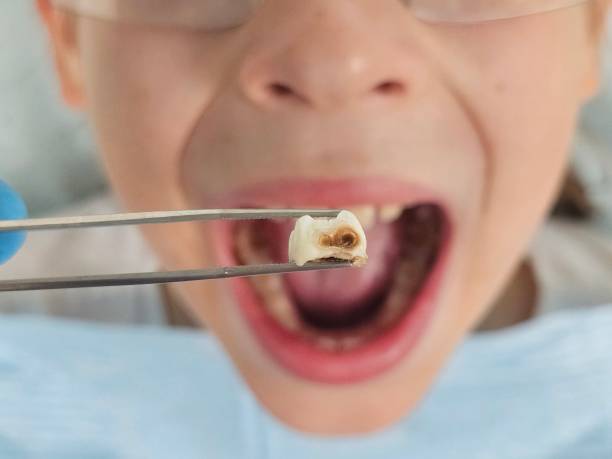Best Emergency Tooth Extraction in Lauderdale, MN